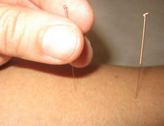 acupunctura